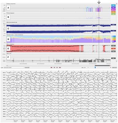 Automated Long-Term EEG Review: Fast and Precise Analysis in Critical Care Patients